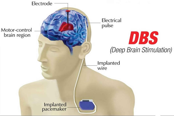 تحریک عمیق مغز( DBS) | ۵ راهکار طلایی برای درمان وسواس چک کردن